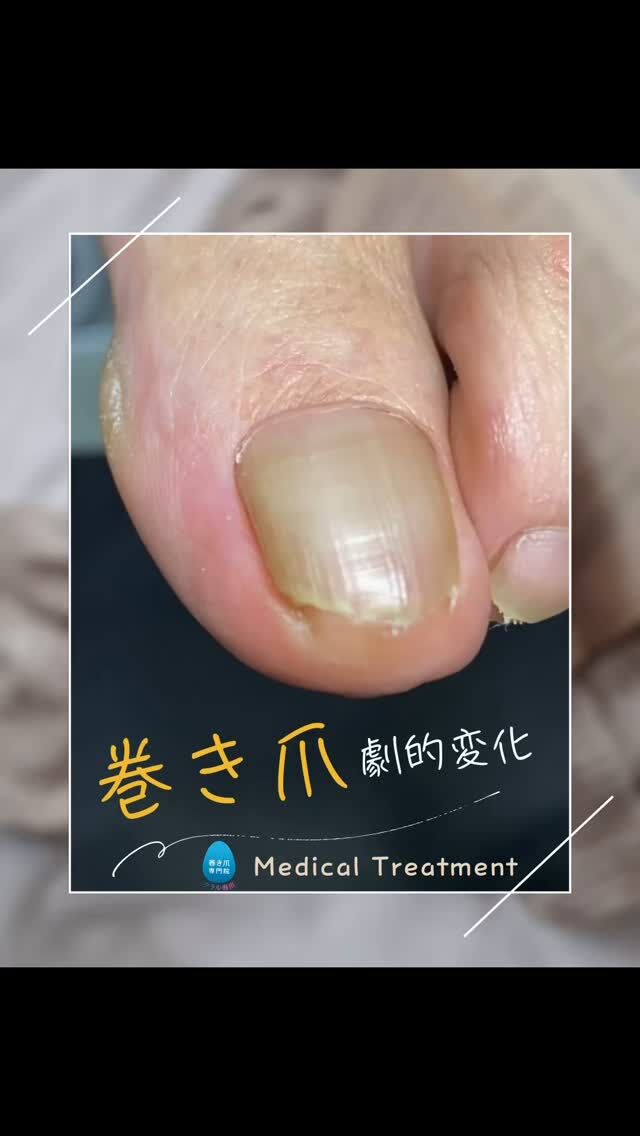 ペディグラス　爪ケア Amazon.co.jp: ペディグラス ネイルオイル (10ml) 爪周りの乾燥